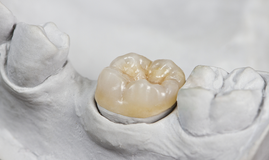 Understanding Inlays & Onlays: A Conservative Approach to Restorative Dentistry